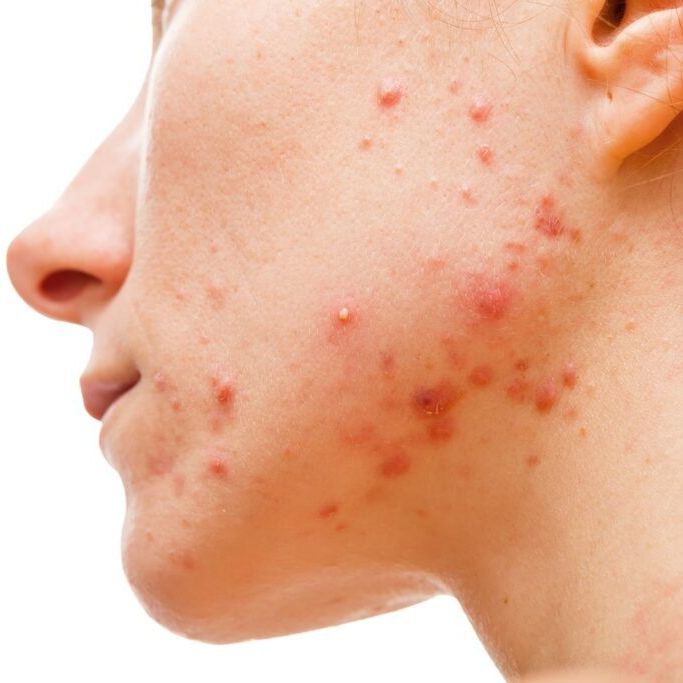 pimples on face