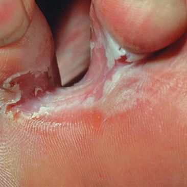 athletes foot toes