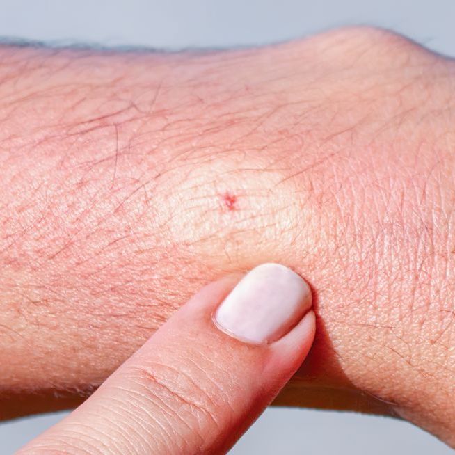 insect bite on arm