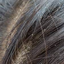 nits in hair