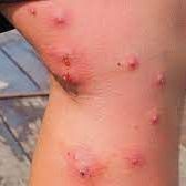infected insect bites