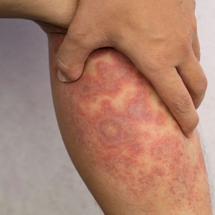 rash on leg