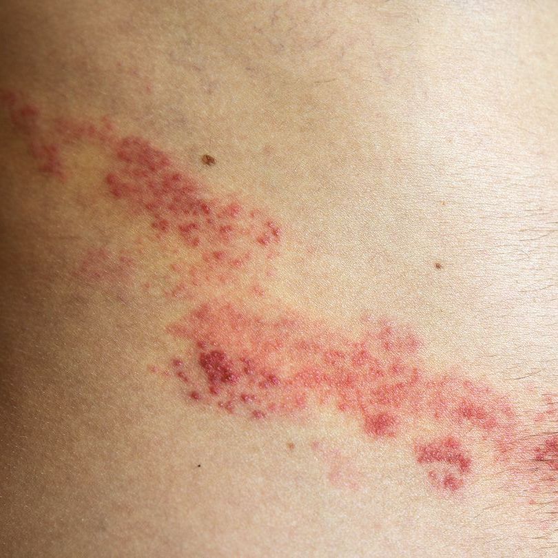 shingles rash