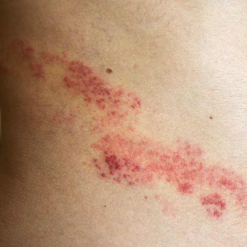 shingles rash