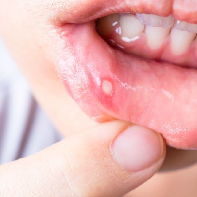 mouth ulcer on lip