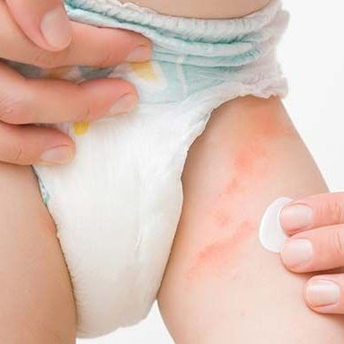 nappy rash