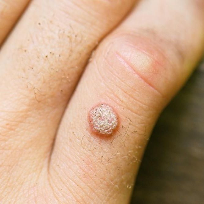 wart on finger