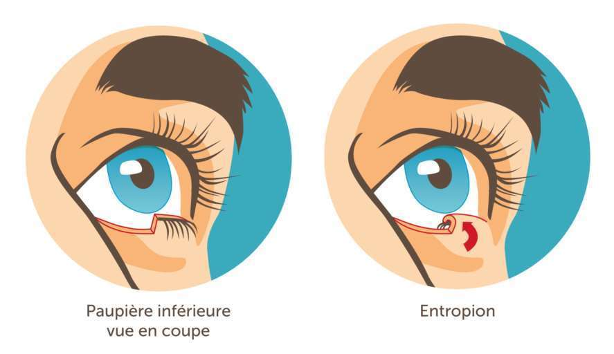 Entropion