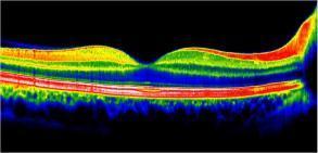 OCT maculaire RNFL nerf optique ganglionnaire