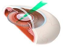 Capsulotomie laser