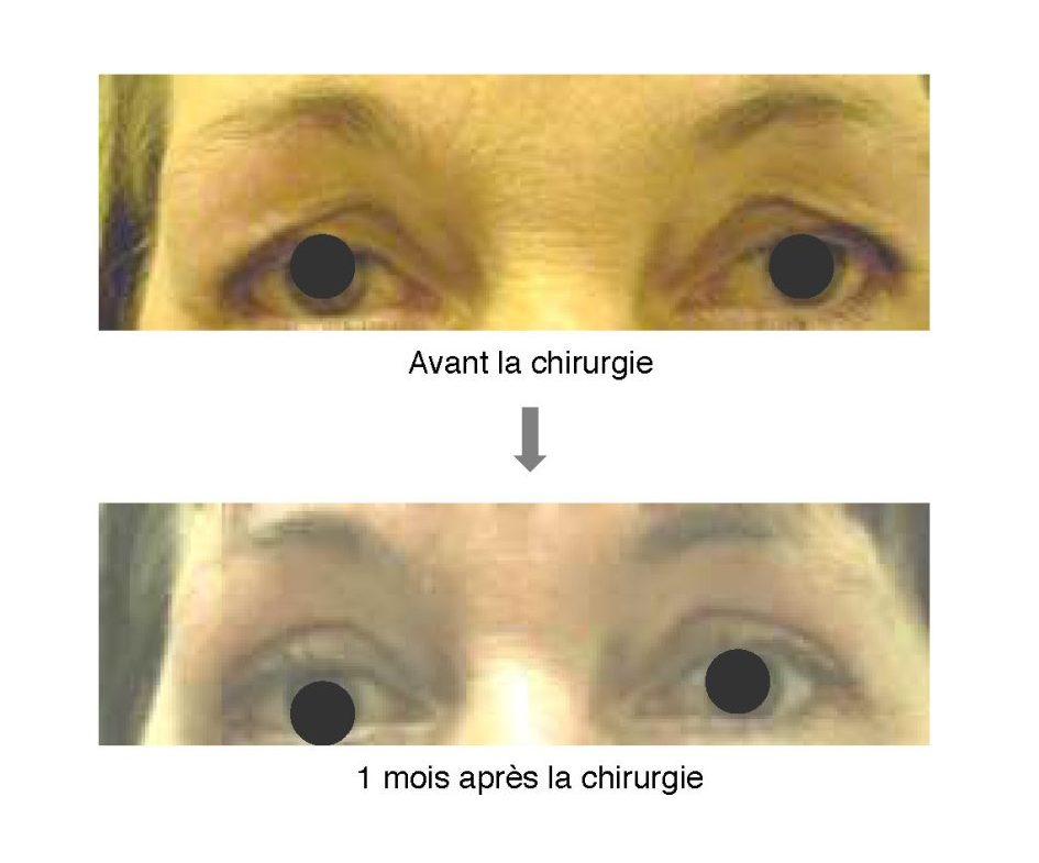 Blépharoplastie