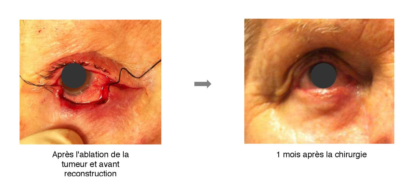 Chirurgie tumeur paupières
