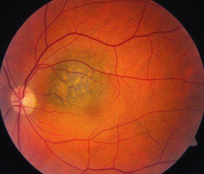 Rétinographie