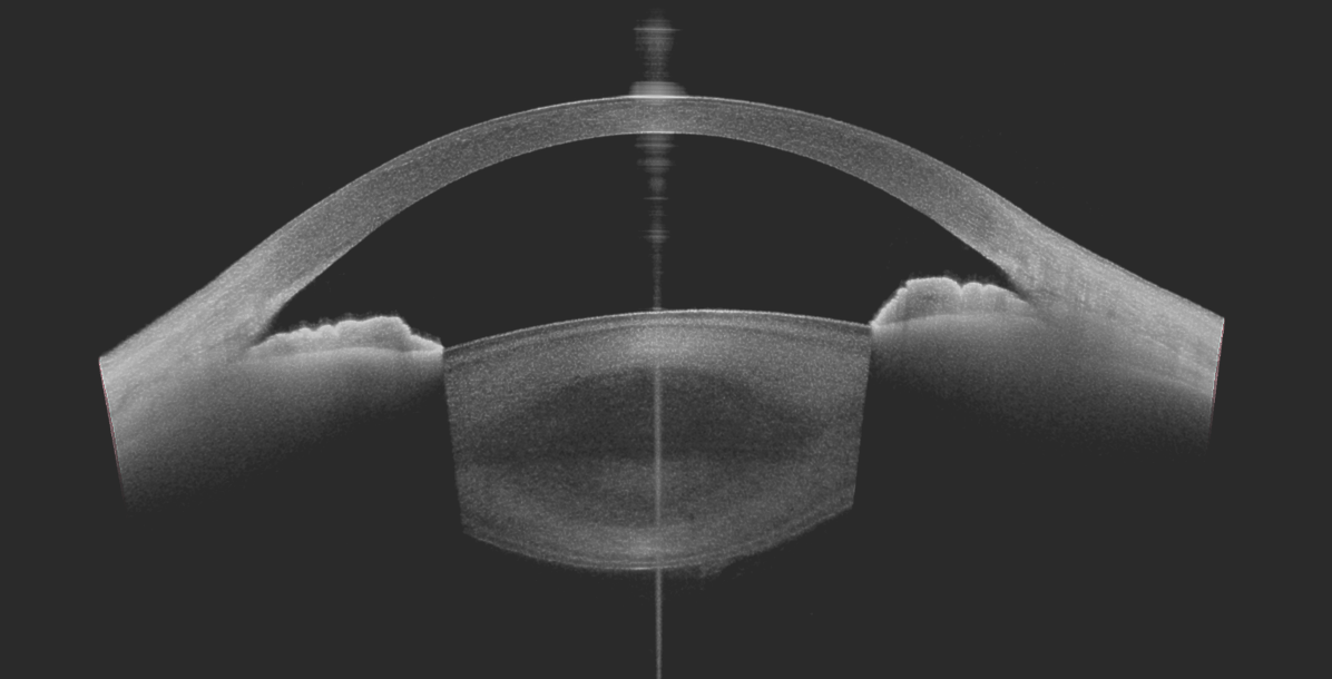 OCT maculaire RNFL nerf optique ganglionnaire