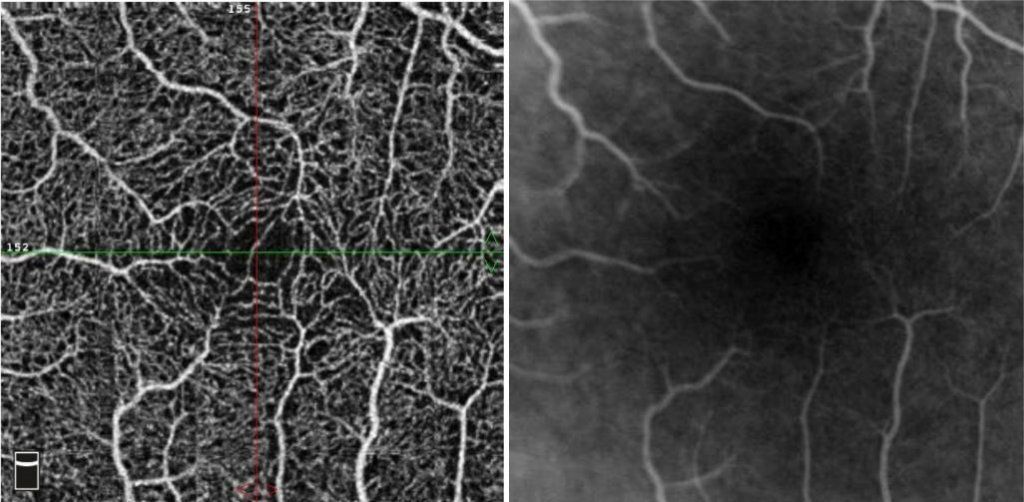 OCT angiographie OCTangio