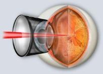 Laser argon rétinopathie diabète