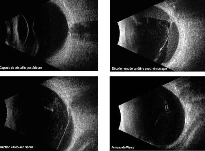 ECHOGRAPHIE OCULAIRE B UBM