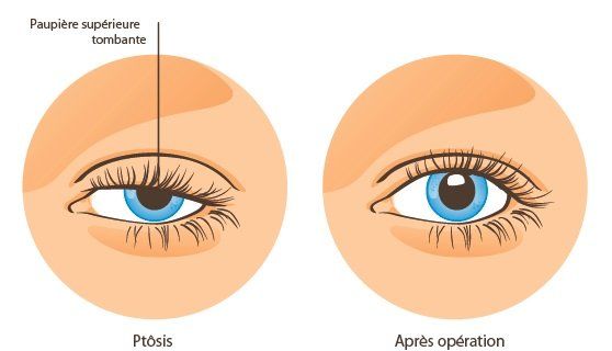 Chirurgie ptosis