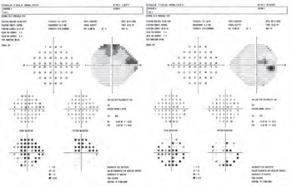 CHAMP VISUEL HUMPHREY