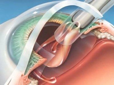 Implant intra-oculaire