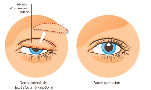 Blépharoplastie