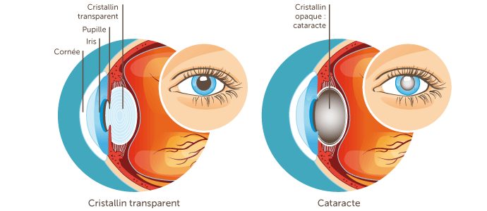 Chirurgie cataracte