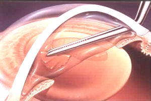 Chirurgie cataracte
