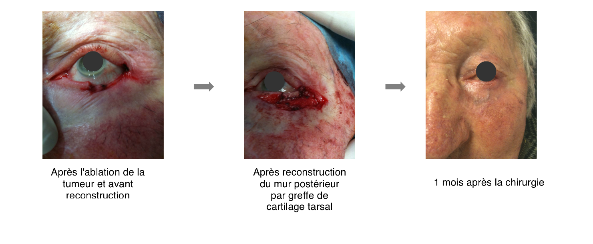 Chirurgie tumeur paupières