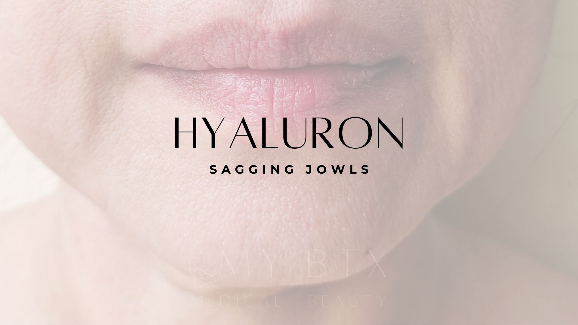 Sagging Jowls sind die kleinen Dellen links und rechts vom Kinn, wenn die Wangenpartie absackt. Dr. Stolz-Fink kann hier durch einen optischen Trick einen sauberen Übergang mit Hyaluronfiller zaubern. MY BTX MEDICAL BEAUTY ist bekannt für schöne, natürliche Ergebnisse bei der Faltenunterspritzung und ist Experte für medizinisches Well-Aging im Hunsrück.