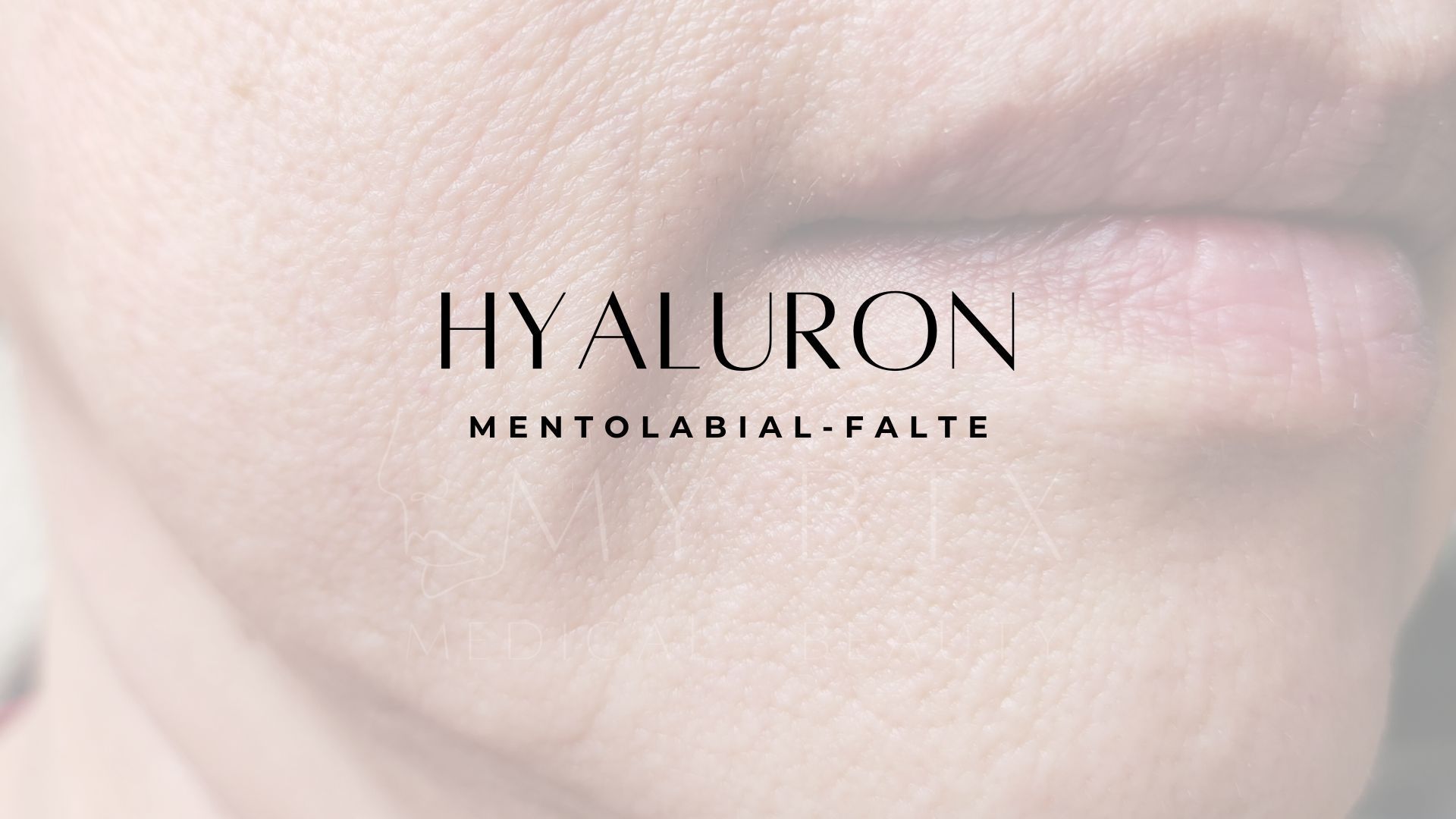 Dr. Stolz-Fink ist bekannt für schöne, natürliche Ergebnisse bei der Faltenunterspritzung und ist Experte für medizinisches Well-Aging im Hunsrück.