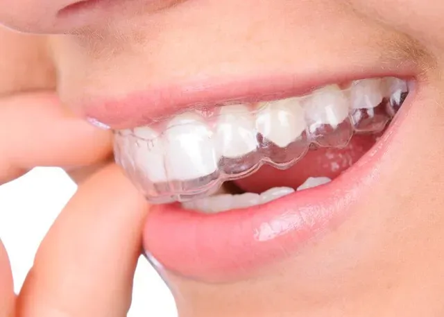Invisalign Methode Zahnarzt Invisalign Methode bei Doz. DDr. Heinz-Dieter Müller, PHD
