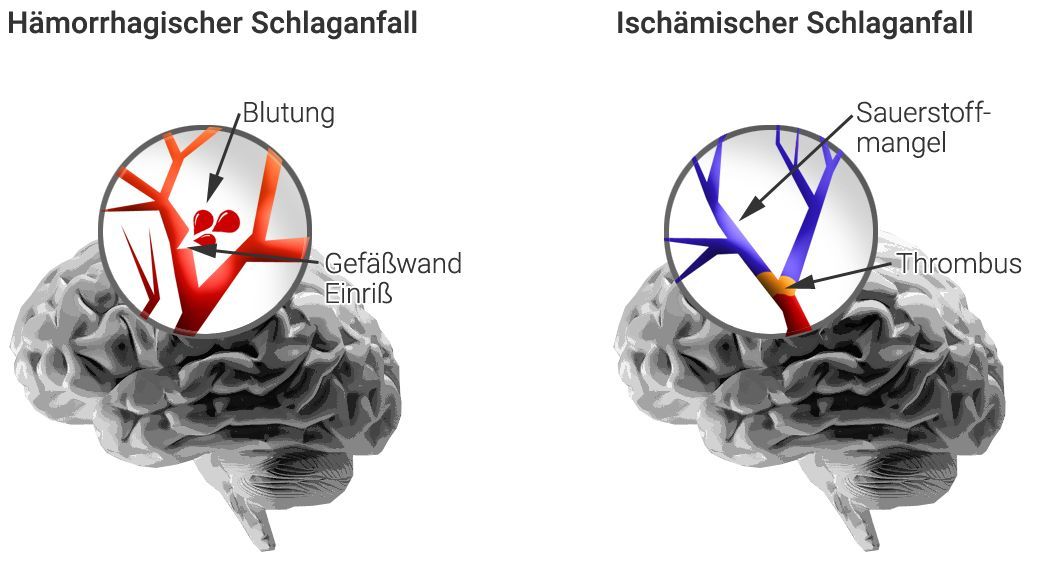 Hämorrhagischer Schlaganfall, Ischämischer Schlaganfall Ischämischer Schlaganfall
Hämorrhagischer Schlaganfall