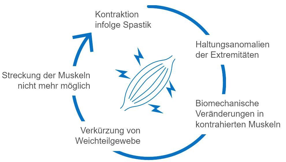 Der Teufelskreis der Spastik Der Teufelskreis der Spastik