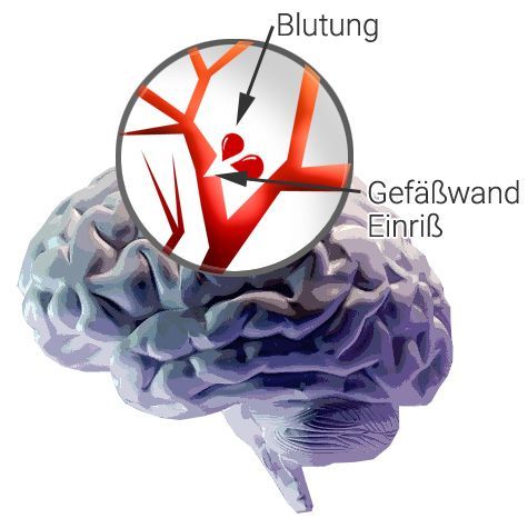 Hämorrhagischer Schlaganfall Hämorrhagischer Schlaganfall