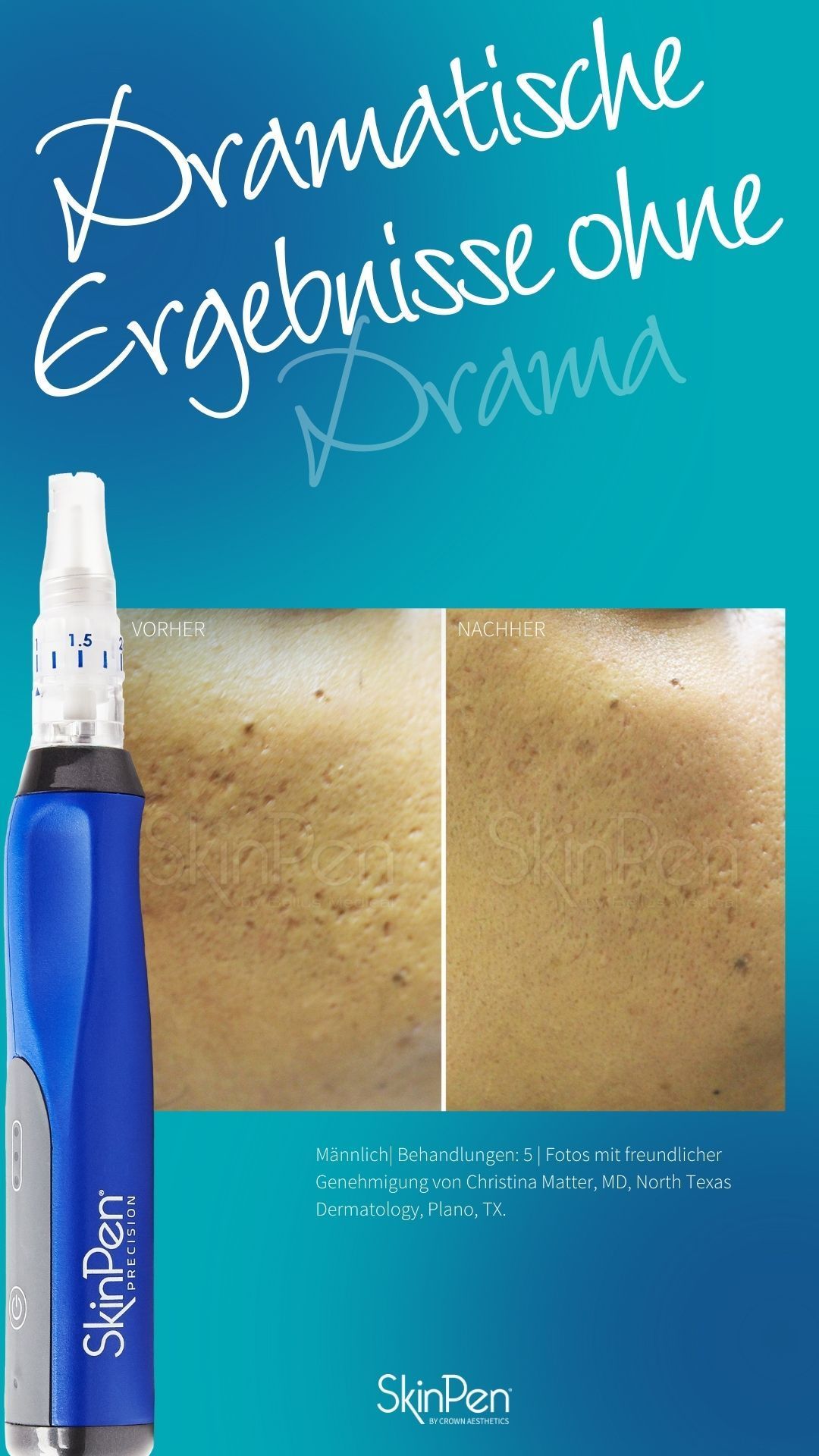 SkinPen® Precision Microneedling SkinPen® Precision Microneedling