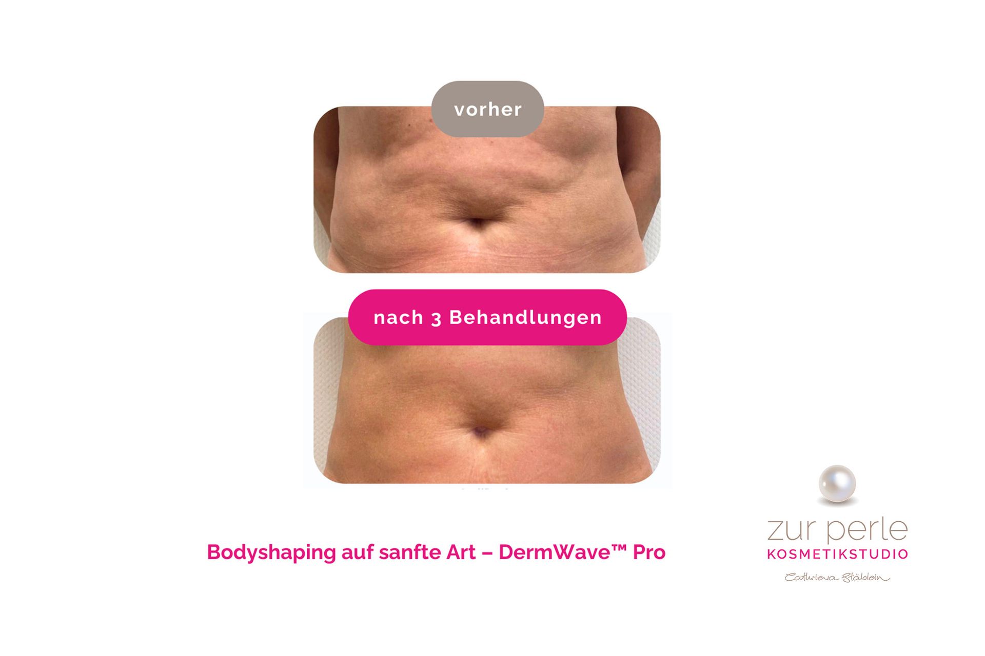 DermWave™ Pro schenkt bereits bei einer Anwendung ein deutlich verbessertes Körpergefühl und ist ideal für den Start in den Sommer.