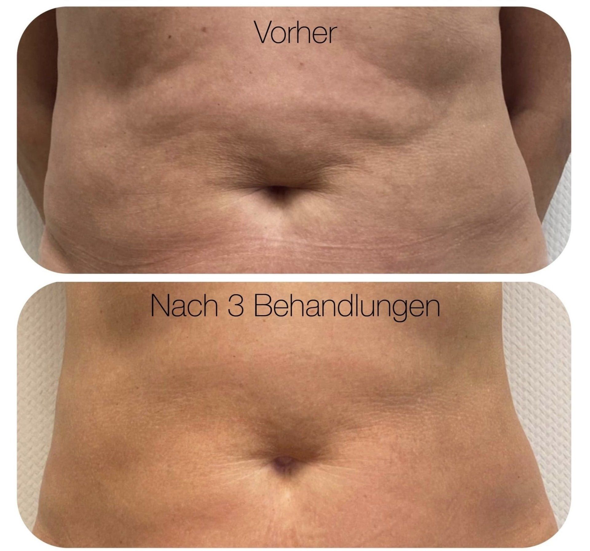 DermWave Pro-Effekt vorher – nachher DermWave Pro-Effekt vorher – nachher