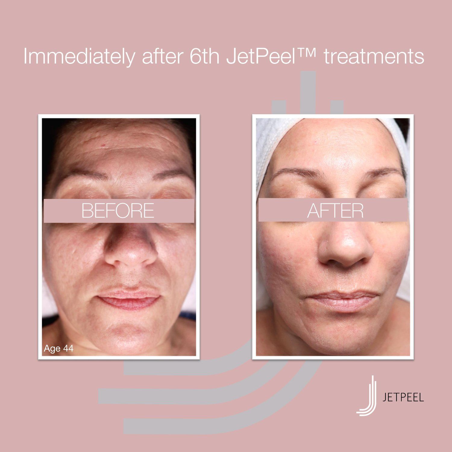 JetPeel-Effekt vorher – nachher JetPeel-Effekt vorher – nachher