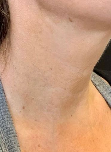 Aesthetic Treatment Ameela performed at HGFace, after