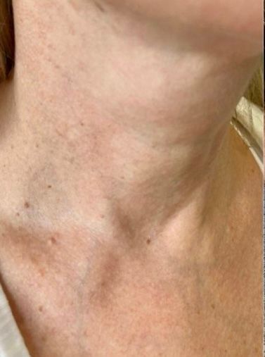 Aesthetic Treatment Ameela performed at HGFace