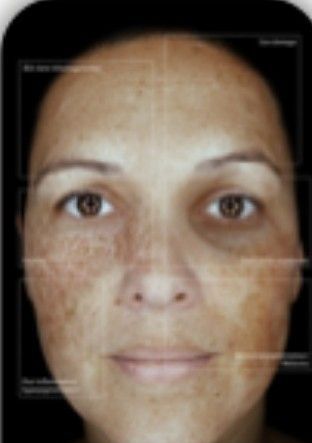 HGFace medical aesthetics - oberv 520x for pigmentation