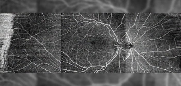 Illustration de l'angiographie et de l'angio-OCT pour le diagnostic des maladies oculaires