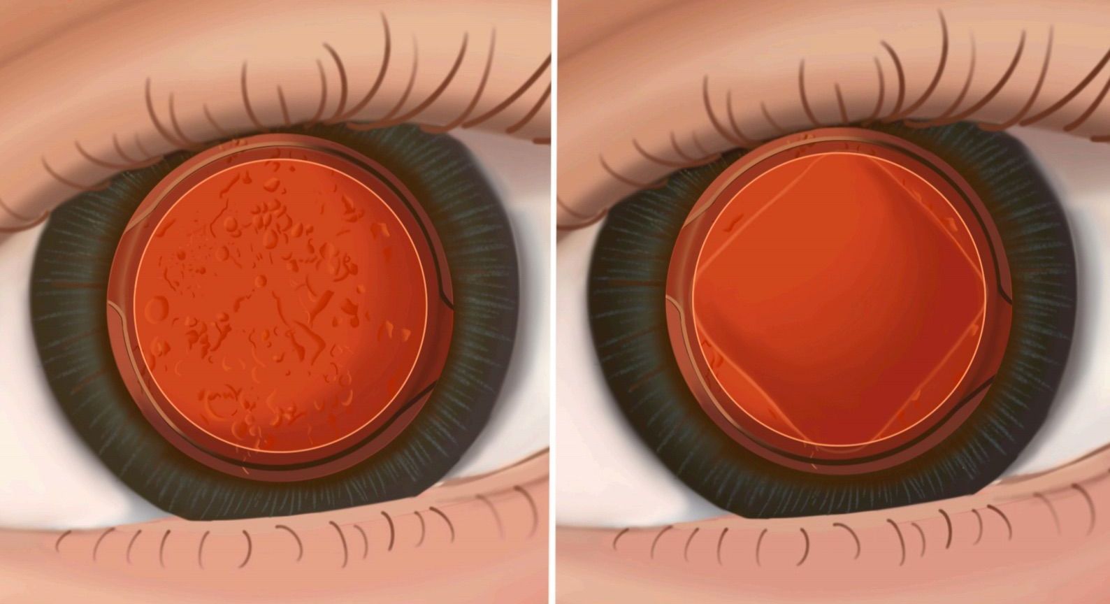 Illustration de la capsulotomie au laser YAG, une procédure post-opératoire pour traiter la formation de capsule postérieure après une chirurgie de la cataracte
