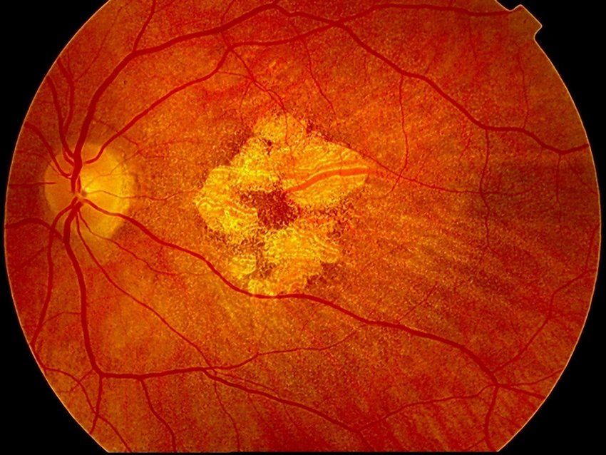 Illustration de la dégénérescence maculaire liée à l'âge (DMLA) avec des injections intravitréennes (IVT), un traitement courant pour ralentir la progression de la maladie