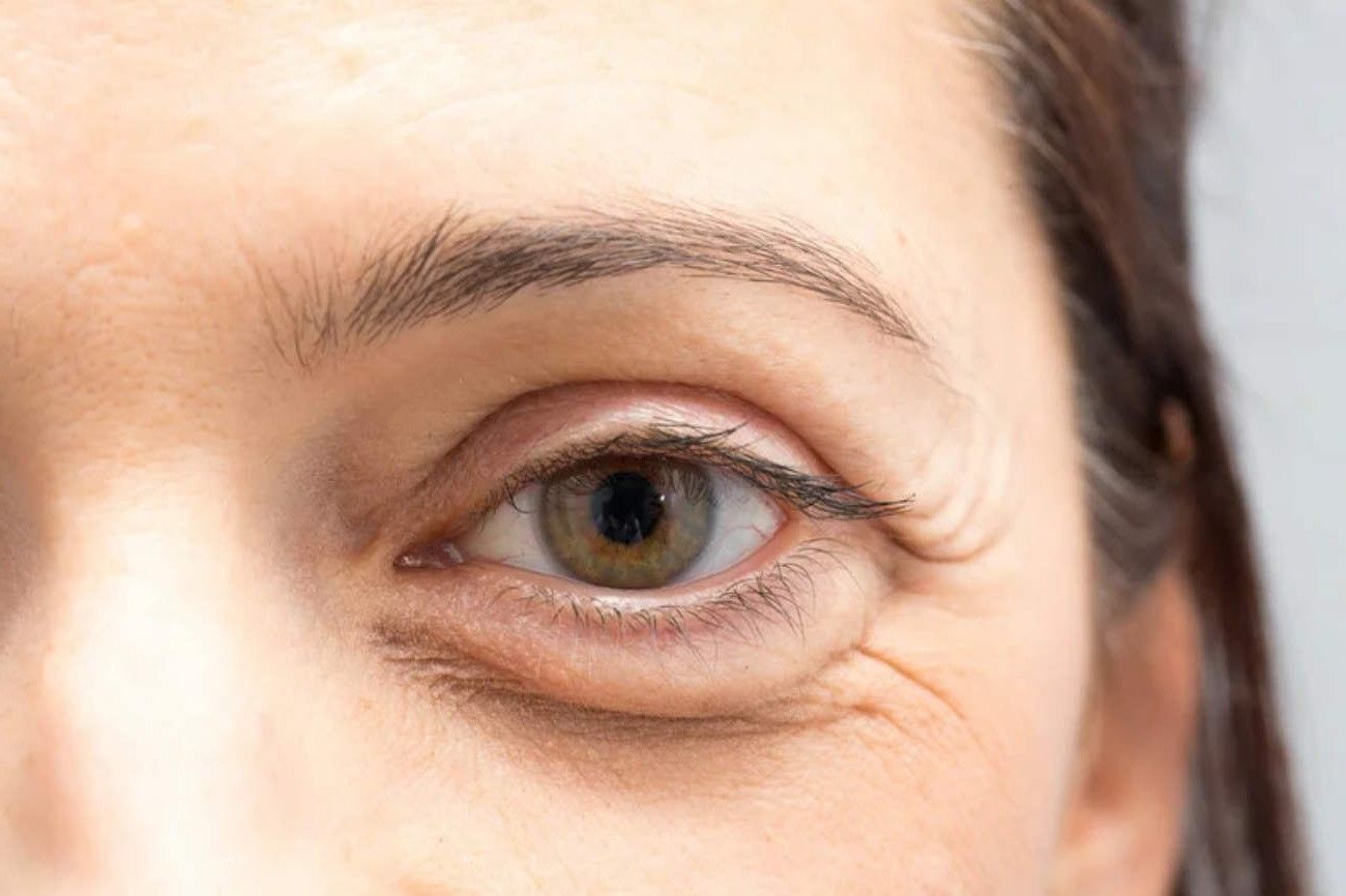 Illustration du dermatochalasis, également connu sous le nom de paupière tombante, une condition où la peau de la paupière supérieure s'affaisse et peut obstruer la vision