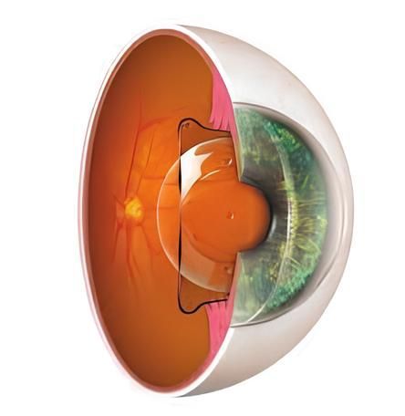 Illustration d'un implant phake, une lentille intraoculaire utilisée pour corriger la vision chez les patients atteints de troubles réfractifs