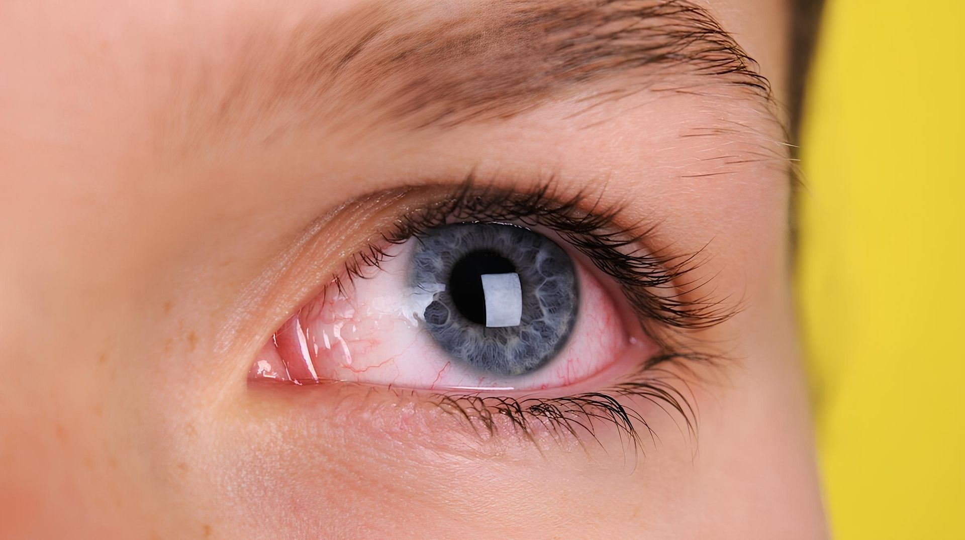 Illustration de la kératite et de la conjonctivite, deux affections oculaires courantes caractérisées respectivement par une inflammation de la cornée et de la conjonctive
