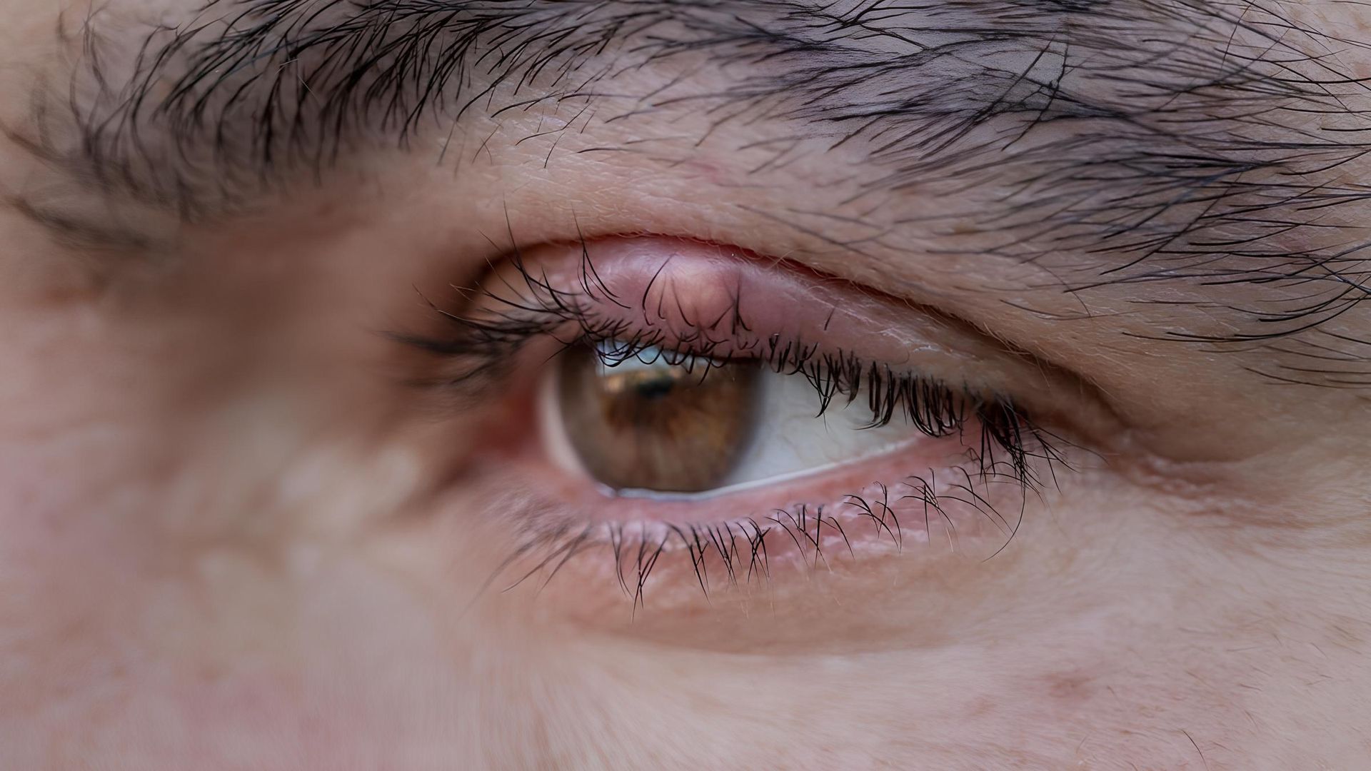 Illustration des lésions et des tumeurs des paupières, comprenant des kystes, des verrues, des carcinomes et d'autres affections cutanées
