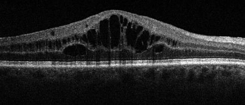 Illustration de la rétinopathie et de la maculopathie diabétique, deux complications oculaires graves du diabète qui affectent la rétine et la macula, entraînant une perte de vision