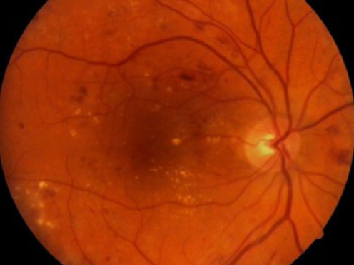 Illustration de la rétinopathie et de la maculopathie diabétique, deux complications oculaires graves du diabète qui affectent la rétine et la macula, entraînant une perte de vision